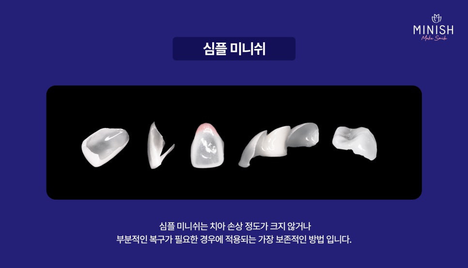 A Complete Guide to the Minish Program That Fits My Teeth image 2