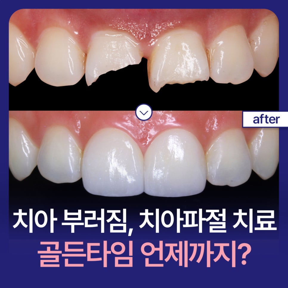 Hakdong Station Dental Clinic: Broken Teeth and Tooth Fracture Treatment — How Long Is the Golden Time? image 1