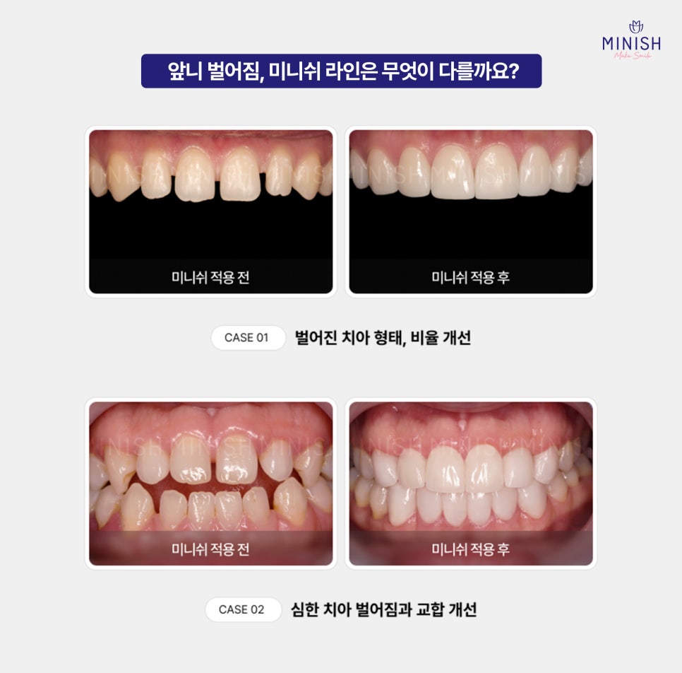 Gaps Between the Front Teeth After Orthodontic Treatment: Addressing Them with the Minish Line image 6