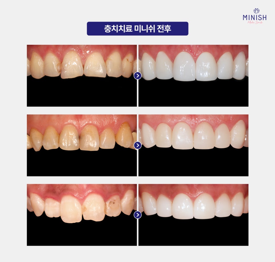 Key Points to Check Before Proceeding with Cavity Treatment Using Resin image 5