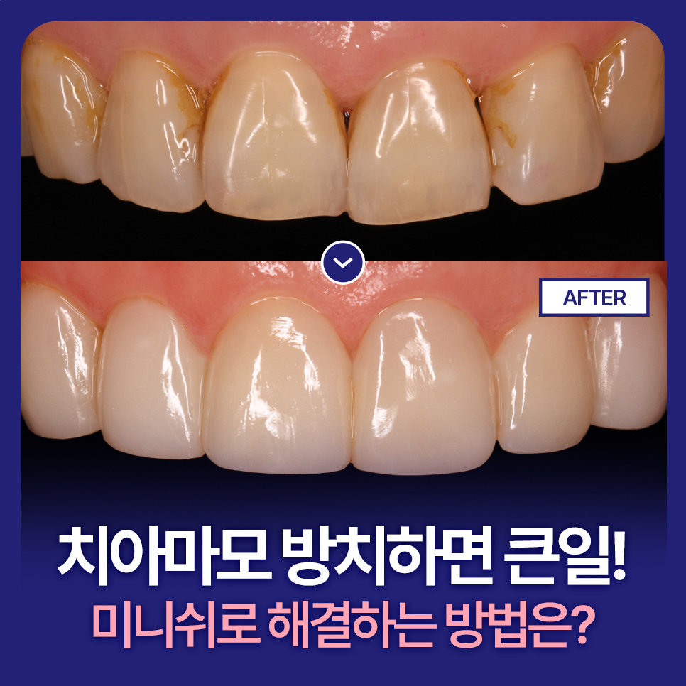 Regret It If You Leave Tooth Wear Untreated! What Are the Ways to Restore It Healthily? image 1