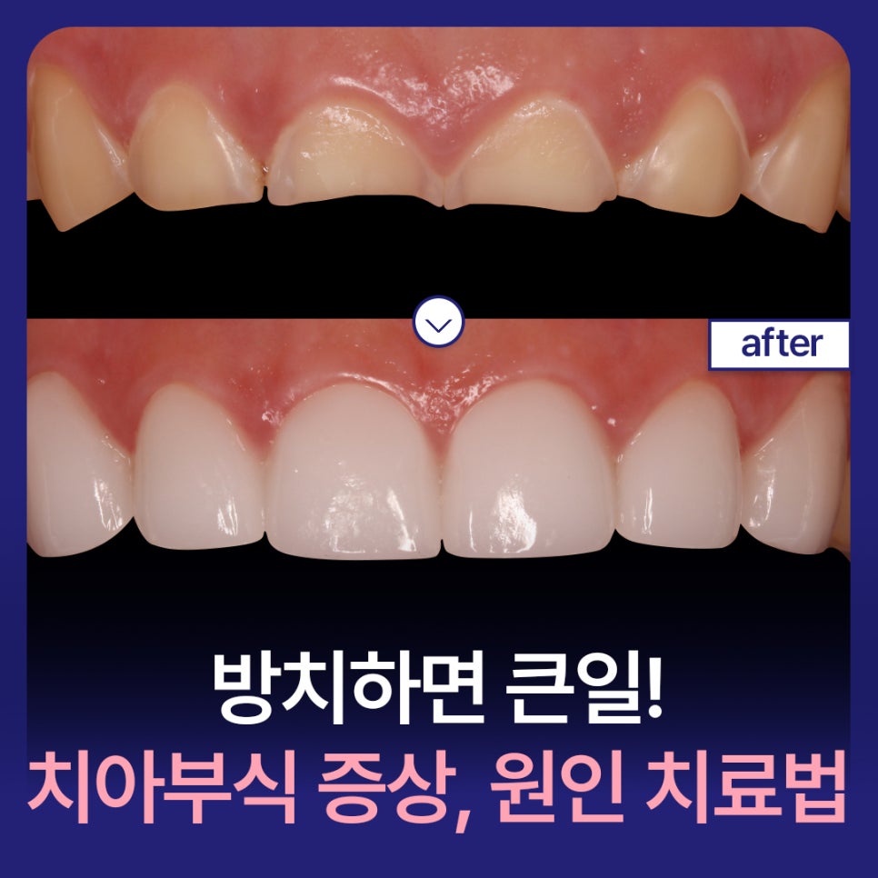 방치하면 큰일! 치아부식 증상 원인 치료 방법엔? 듀얼미니쉬 관련 이미지 1