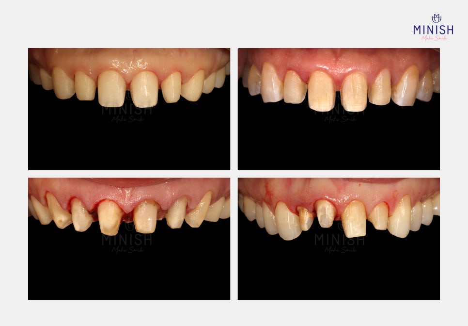 If You’re Considering Laminate Retreatment, Be Sure to Learn About the Side Effects and Healthy Restoration Methods! image 4