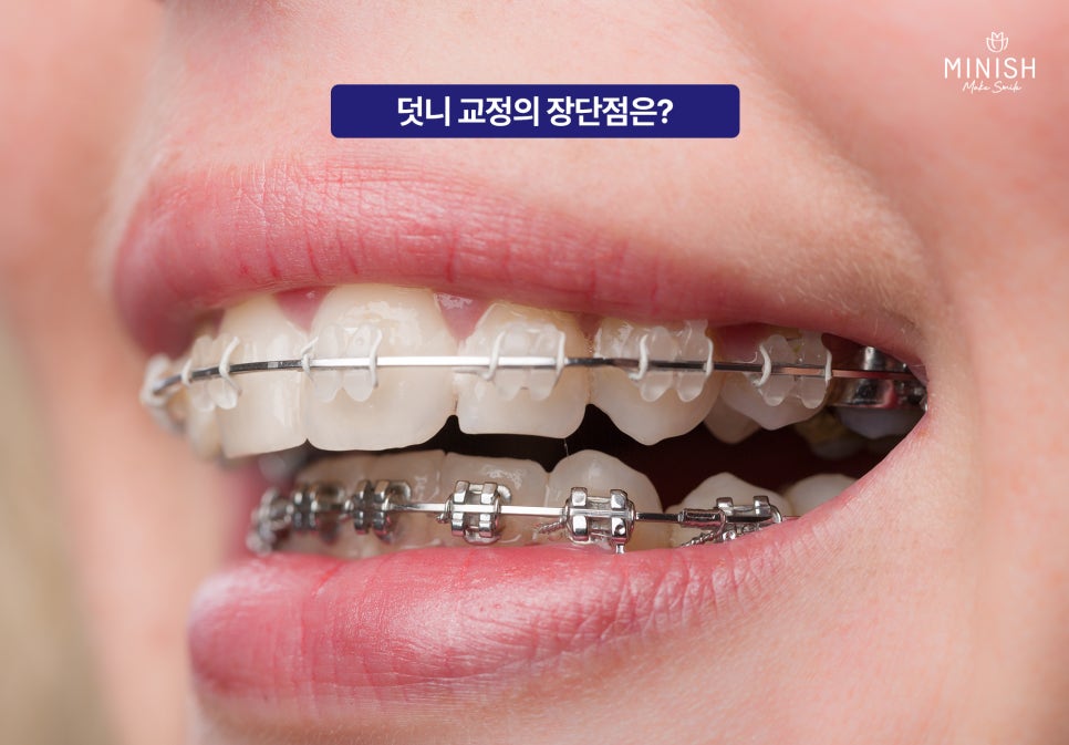 Complex About Crooked Canines? Improve Quickly Without Orthodontics with Minishe Harmony! image 3