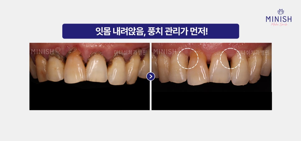 Causes of Receding Gums, Early Signs of Gum Disease, and When Gum Disease Treatment Is Needed image 6