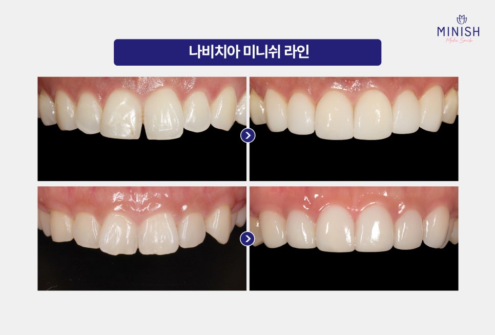 Crooked Front Teeth and the Butterfly Teeth Complex: Why Improving Tooth Shape and Proportions Matters / Minish Line image 5