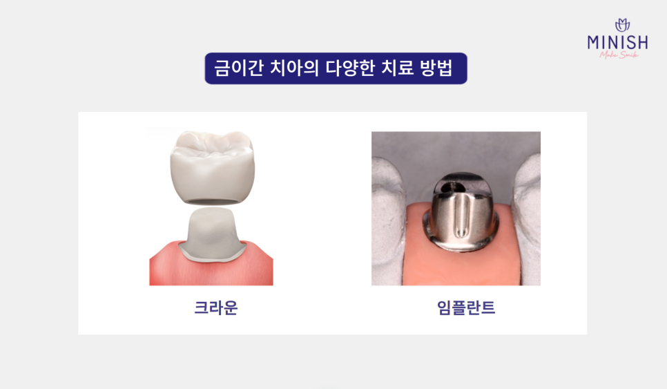 Cracked Teeth, from Cause to Treatment! How to Regain Healthy Teeth image 6