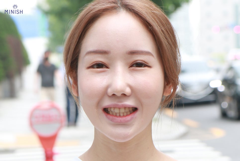 누런니 고민은 치과 치아미백 아닌 원데이미니쉬 관련 이미지 5