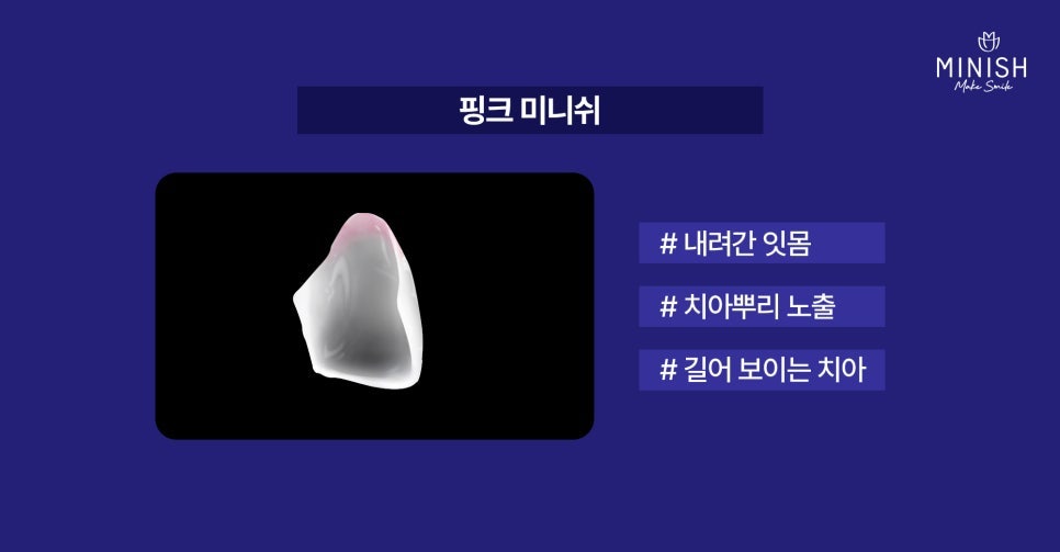 Swollen Gums and Bleeding? Warning Signs of Periodontal Disease image 8