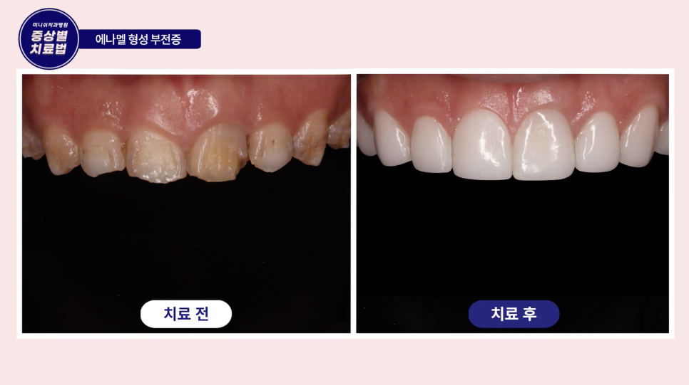 치아미백의 거의 모든 것 관련 이미지 8