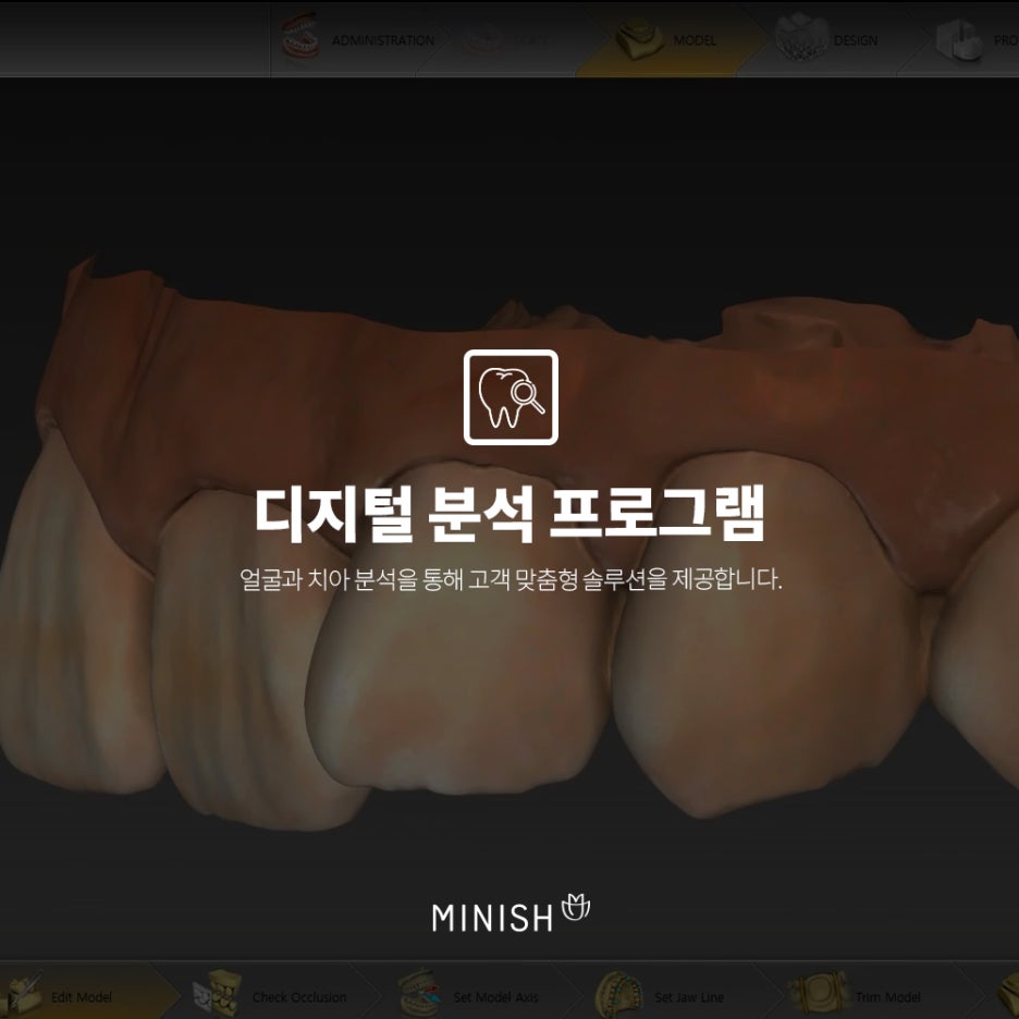 뻐드렁니, 덧니! 치아틀어짐 하루만에 해결하는 미니쉬가격은? 관련 이미지 5