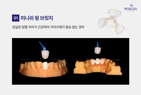 치아 브릿지 vs 미니쉬 브릿지 : 내 치아를 지키는 최적의 선택은? 관련 이미지 4