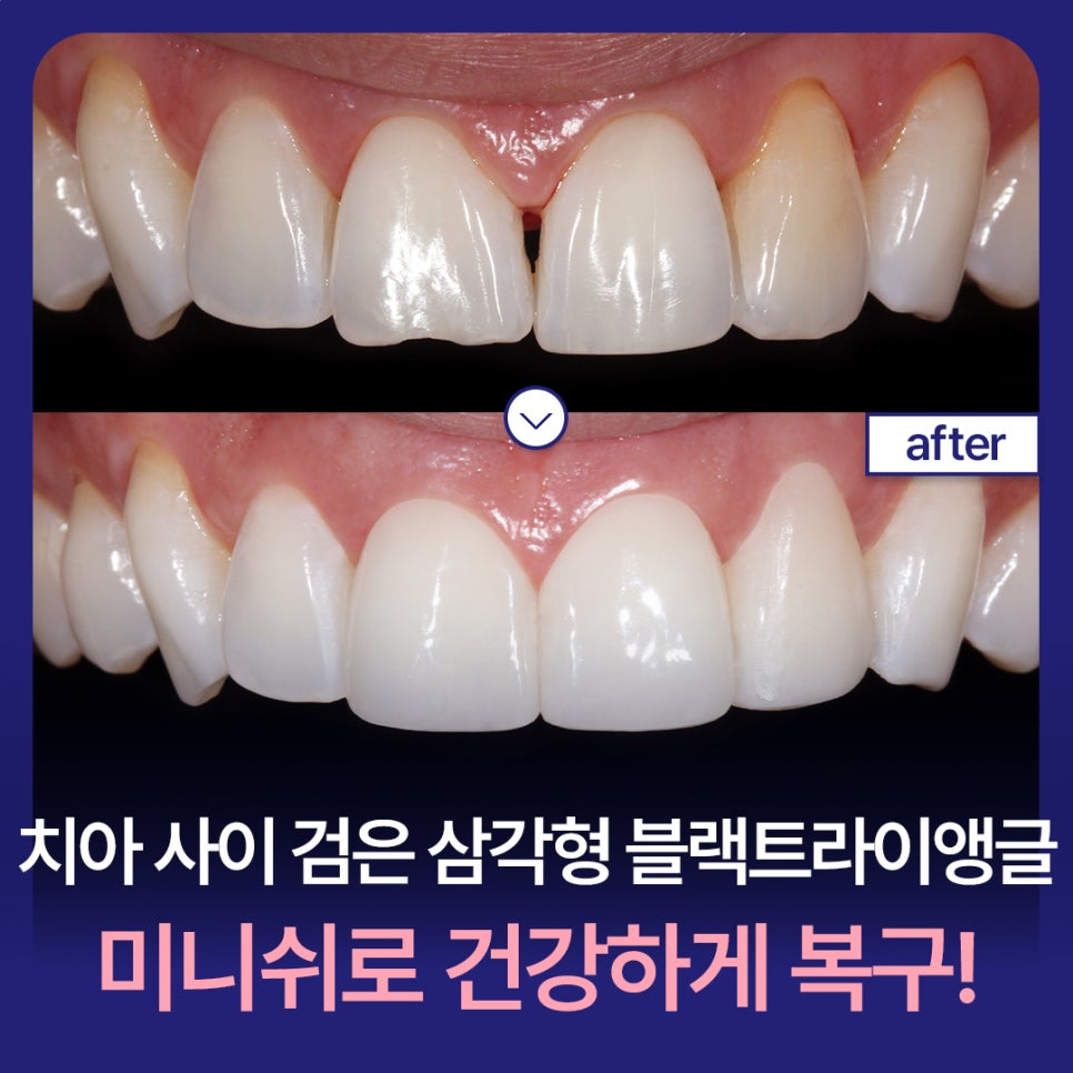 Black Triangles Between Teeth: Restore Them Healthily with Minishe! image 1