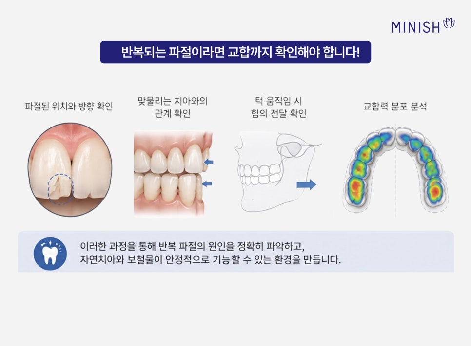 앞니 라미네이트 깨짐, 재치료가 필요하다면? 관련 이미지 5