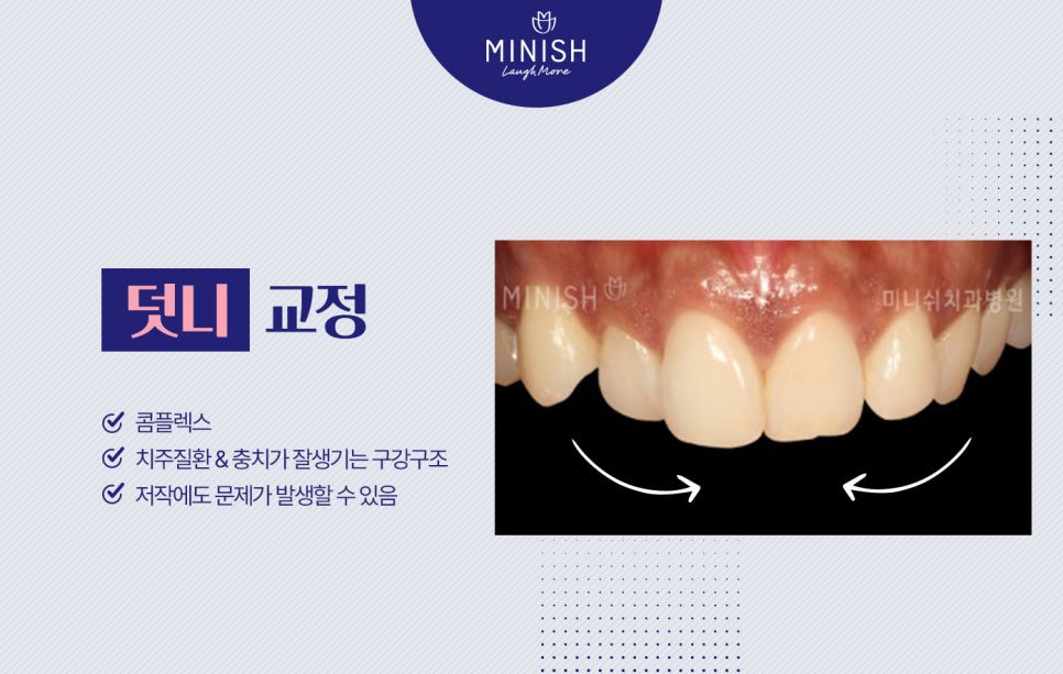 부정교합종류, 하루만에 교정할 수 있는 방법도 있을까? 관련 이미지 2