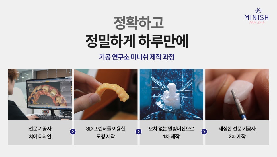 원데이라미네이트와 미니쉬 원데이 시스템 왜 다르고, 무엇이 나을까? 관련 이미지 5