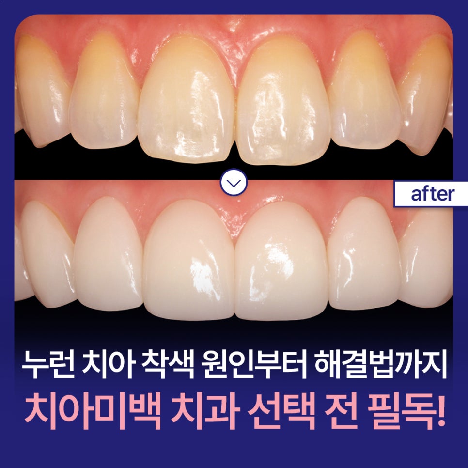 누런 치아 착색 원인부터 해결법까지, 치아미백치과 선택 전 필독! 관련 이미지 1