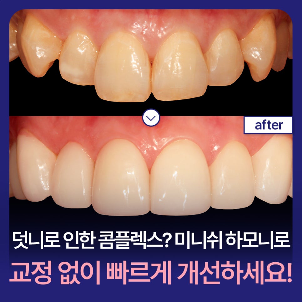 Complex About Crooked Canines? Improve Quickly Without Orthodontics with Minishe Harmony! image 1