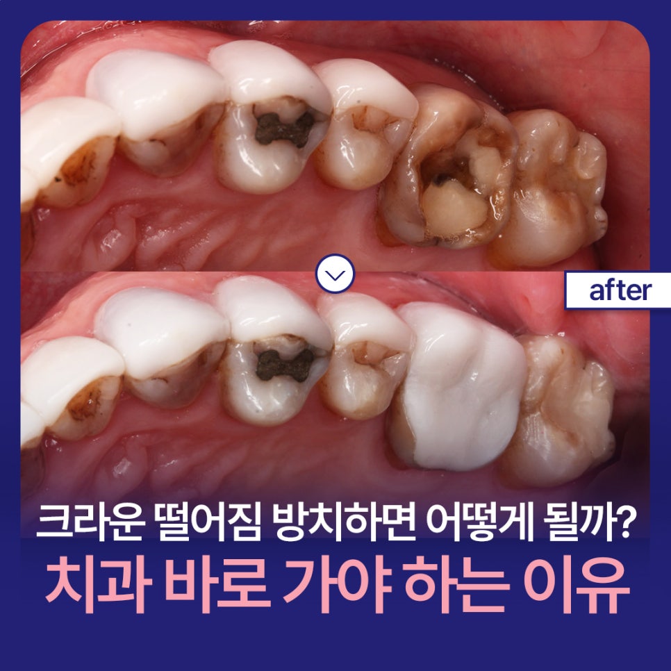 What Happens If You Leave a Fallen Crown Alone? Why You Need to Visit the Dentist Right Away image 1