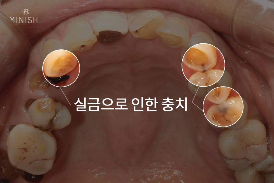 치아실금 방치하면 큰일! 치아코팅으로 건강 되찾으세요 [엄마는예뻤다치과] 관련 이미지 3
