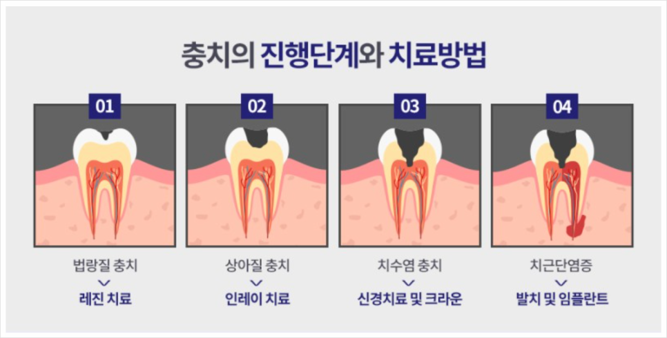 크라운치료의 거의 모든 것 관련 이미지 2