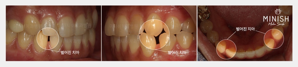 벌어진 치아로 잃어버린 자신감, 미니쉬로 되찾다 관련 이미지 3