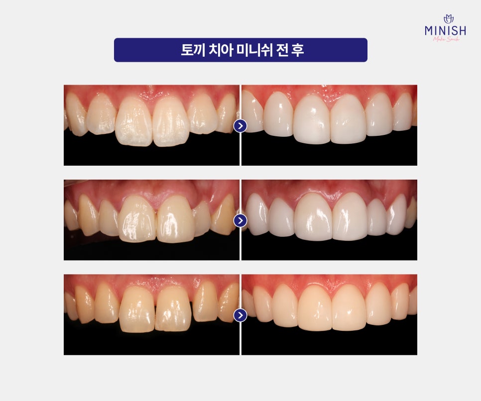 If Rabbit Teeth Are Stressing You Out, Improve Them Healthily with Minishe! image 4