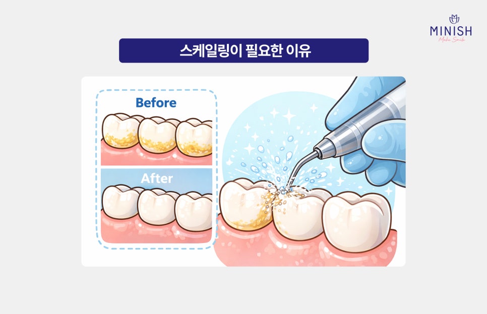 Oral Care Starting with Scaling: What Is a Healthier Way to Manage It? image 2