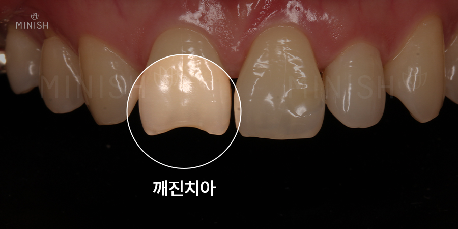 깨진 치아의 다양한 치료법과 미니쉬 비용은? 관련 이미지 3