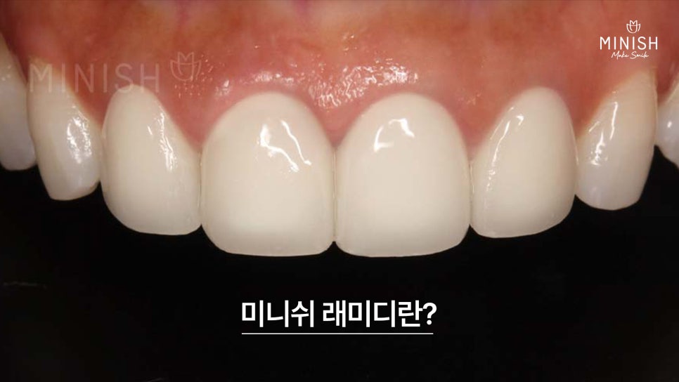 앞니 크라운 재치료가 필요하다면? 미니쉬로 건강하게 복구하세요 관련 이미지 4