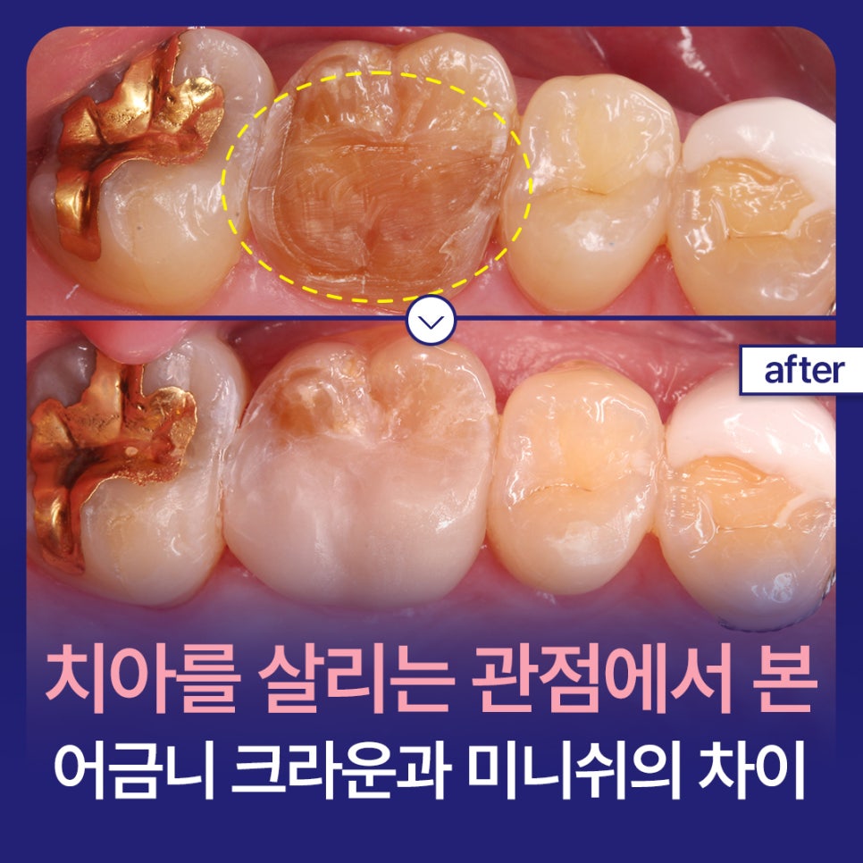 The Difference Between Molar Crowns and Minish from the Perspective of Preserving Teeth image 1