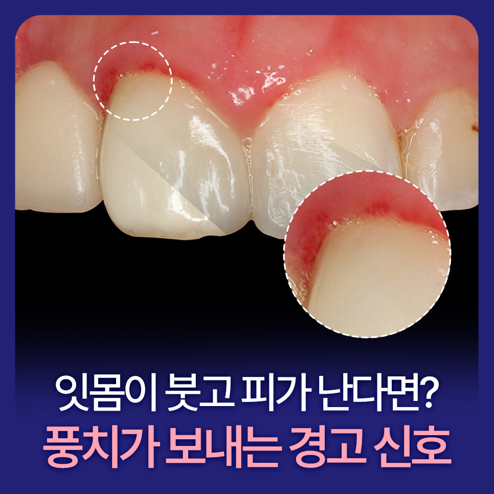 Swollen Gums and Bleeding? Warning Signs of Periodontal Disease image 1