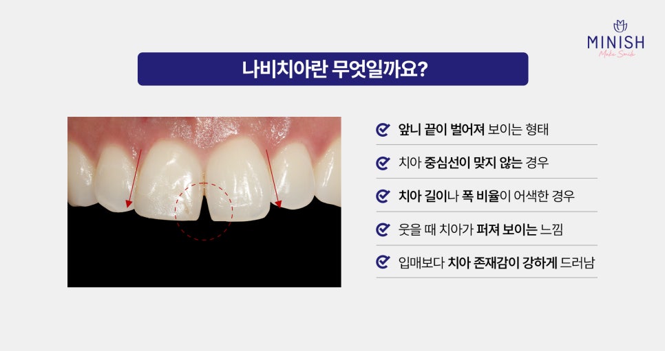Crooked Front Teeth and the Butterfly Teeth Complex: Why Improving Tooth Shape and Proportions Matters / Minish Line image 2