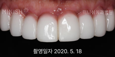 잇몸 내려앉음, 잇몸퇴축 원인과 치료 방법은? 관련 이미지 8