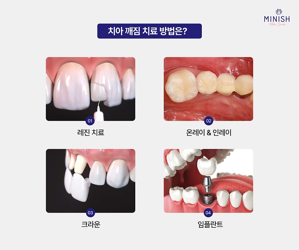 How Can Cracked Teeth Be Repaired Quickly and Healthily? A Complete Guide to Treatment Options image 4