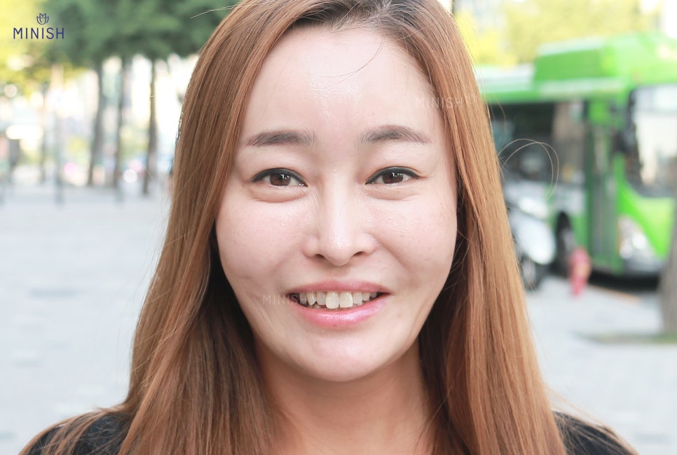 강남치과에서 큰앞니 치료하고 미소를 되찾다! 관련 이미지 2