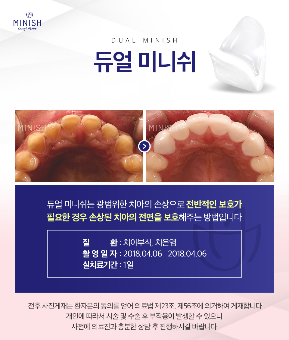 앞니 손상이 걱정된다면 치아미니쉬 관련 이미지 6