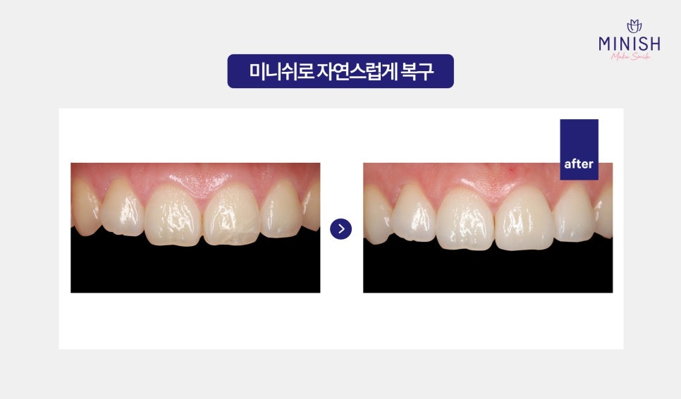 Cracked Teeth, from Cause to Treatment! How to Regain Healthy Teeth image 7