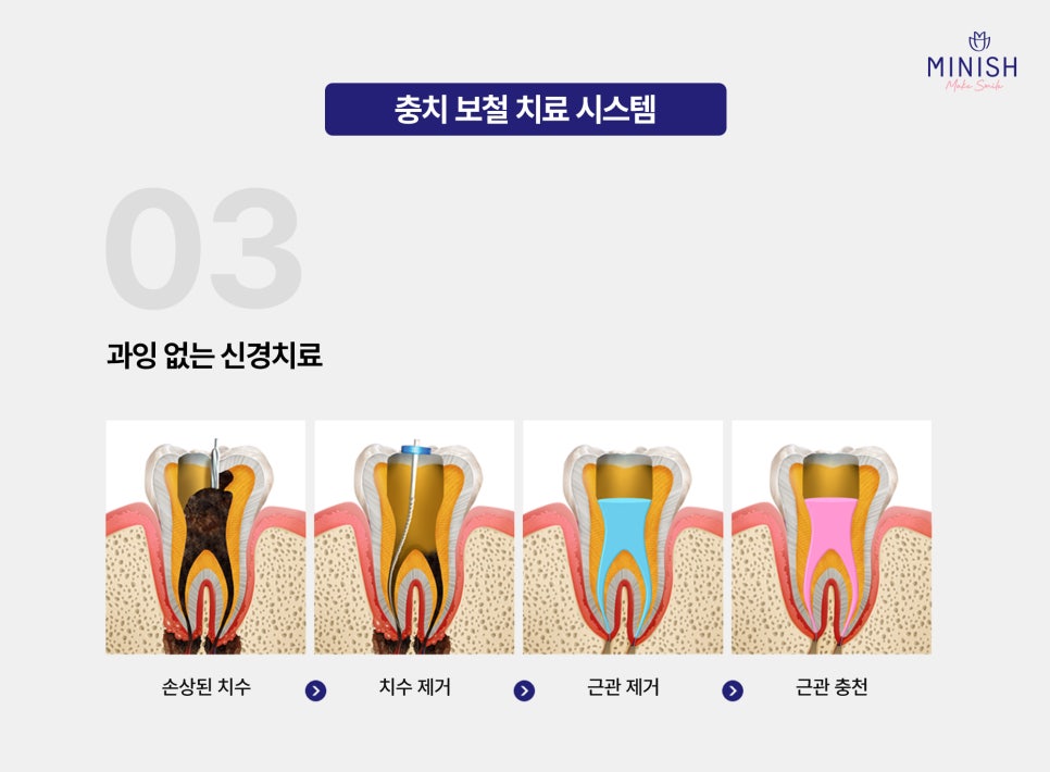 What Is the Best Way to Treat Cavities? What Is a Healthy Way to Protect My Teeth? image 8