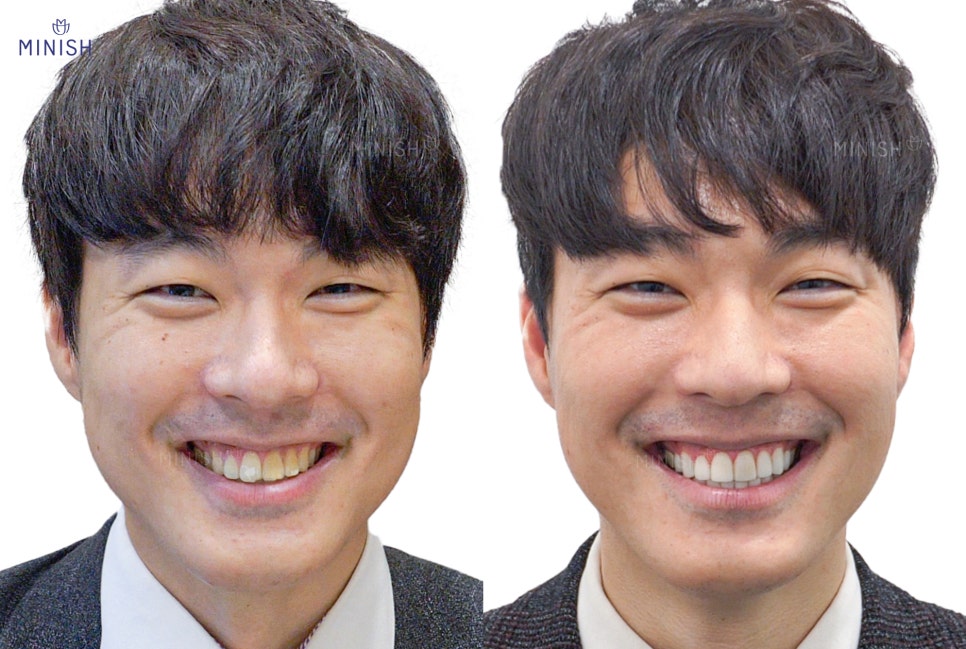 누런니 고민은 치과 치아미백 아닌 원데이미니쉬 관련 이미지 3