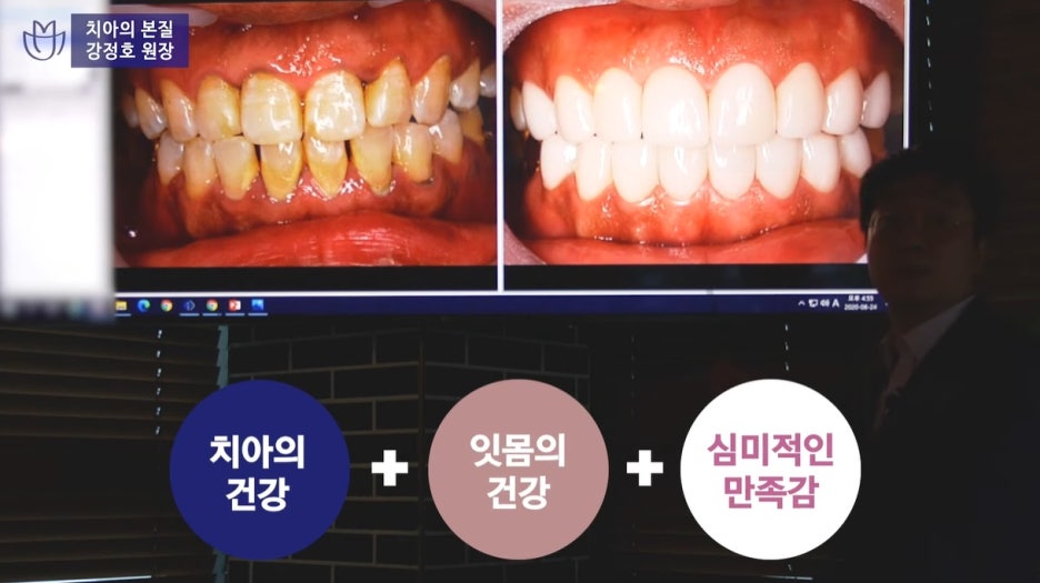 잇몸염증은 구강 적신호...가장 적극적인 잇몸치료는 미니쉬 관련 이미지 22