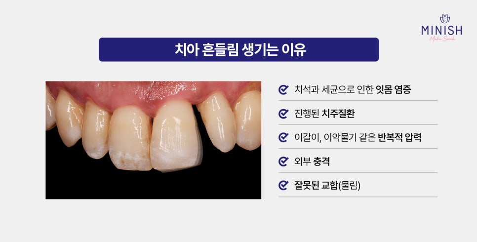 강남구청역치과 치아 흔들림 원인, 방치하면 생기는 변화 관련 이미지 2