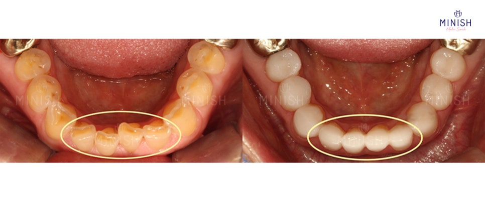 Tooth Wear: What Causes It? How to Restore Teeth Healthily image 7
