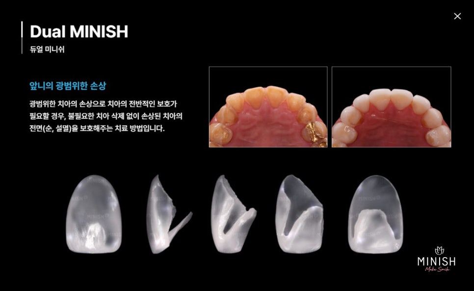 Tooth Wear: What Causes It? How to Restore Teeth Healthily image 8