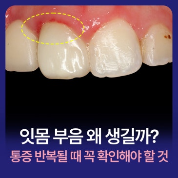 잇몸 부음 왜 생길까? 통증 반복될 때 꼭 확인해야 할 것
