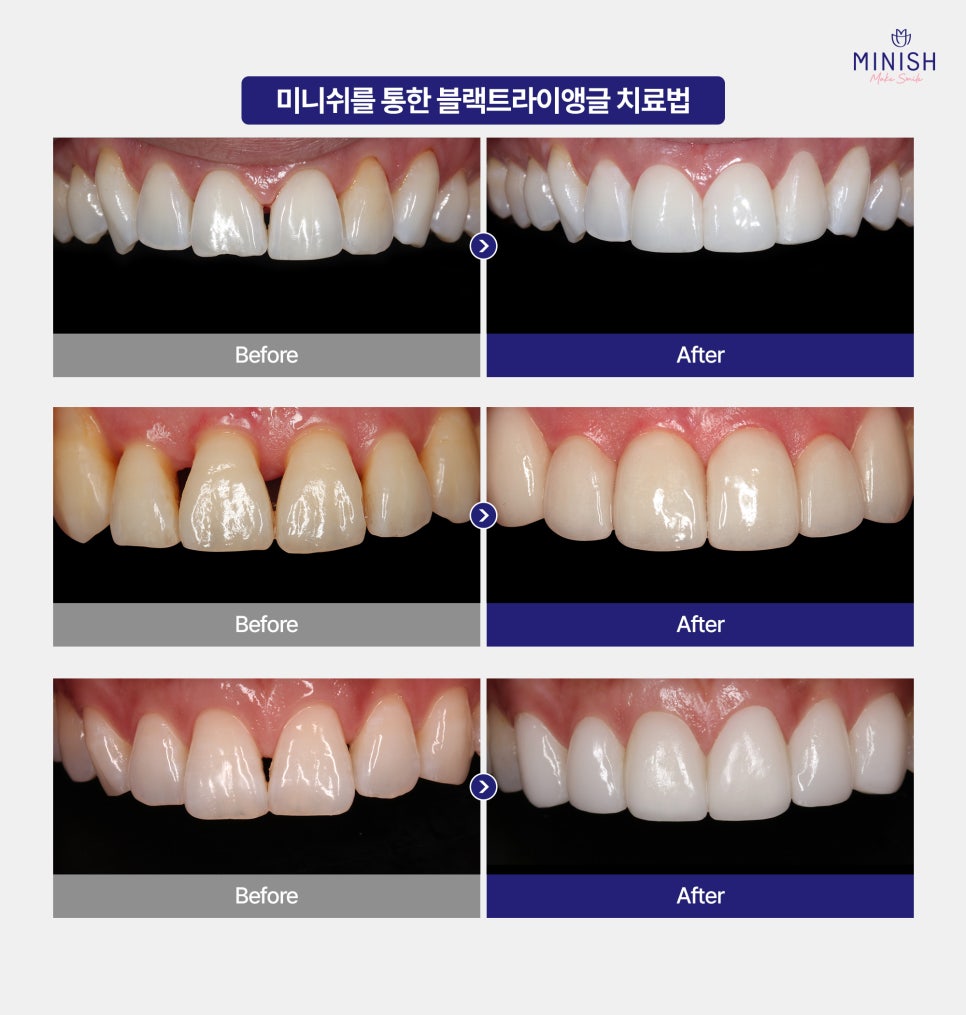 앞니 블랙트라이앵글 증상 원인, 레진 치료 한계와 미니쉬 관련 이미지 5