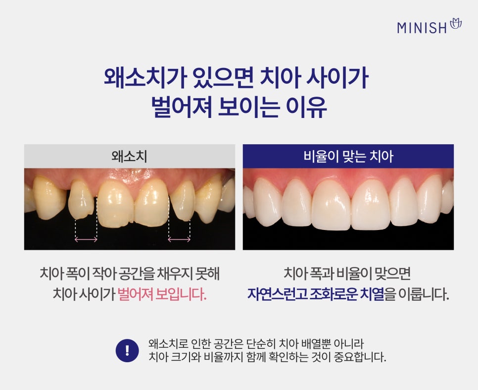 왜소치 교정만으로 작은치아 고민이 해결되지 않을 땐? 미니쉬 심플 관련 이미지 2