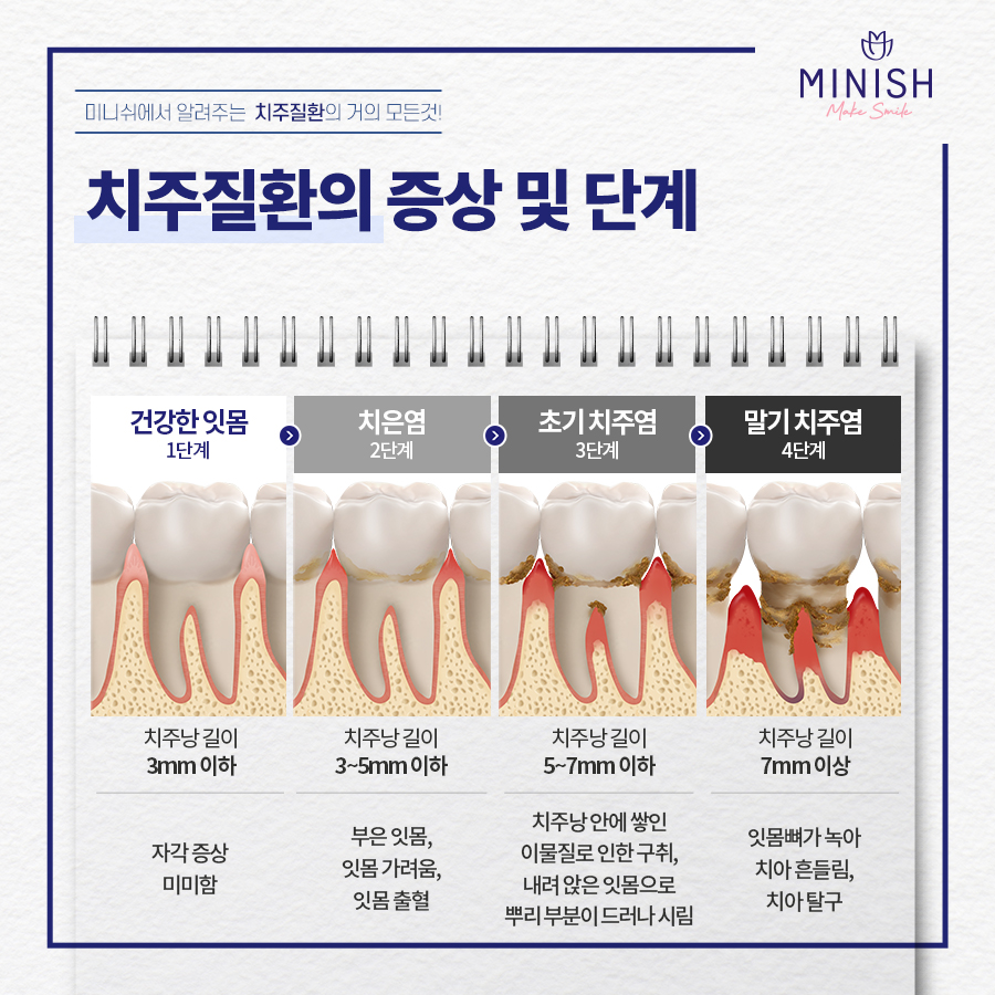 '치주질환'의 거의 모든 것 +잇몸/풍치 자가 체크 관련 이미지 4