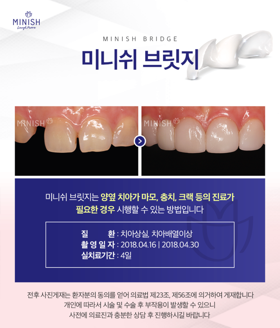 압구정역치과 임플란트 식립이 어려운 경우라면 관련 이미지 4