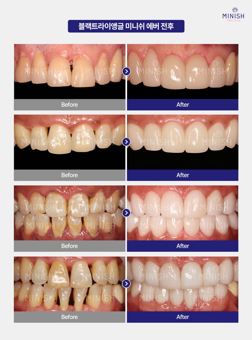 Black Triangles Between Teeth: What Causes Black Triangles and How Can They Be Resolved? image 7
